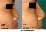 Before After Pictures,Nose job,Rhinoplasty,Delhi,nose  tip augmentation,rhinoplasty